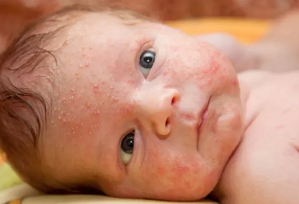 Rash in Babies